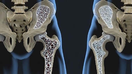 Catanzaro, celebrata giornata mondiale osteoporosi Iniziativa sul tema da parte dell’unità operativa Riabilitazione della Casa della Salute di Chiaravalle Centrale